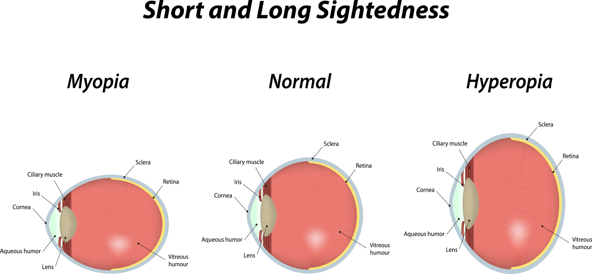 What Is The Meaning Of Myopia And Hypermetropia