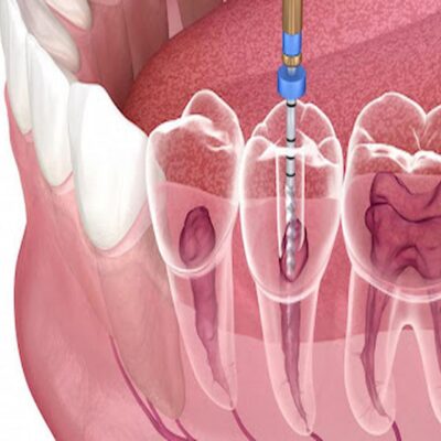 How Root Canal Therapy Works: A Step-by-Step Guide
