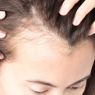 Top 10 Myths About Baldness