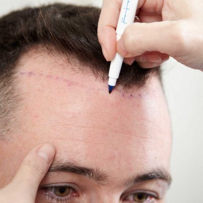 When Considering A Hair Transplant, Choose Your Options Carefully