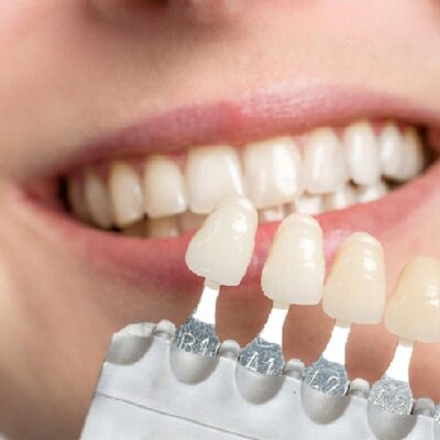What You Need To Know About Dental Veneers?
