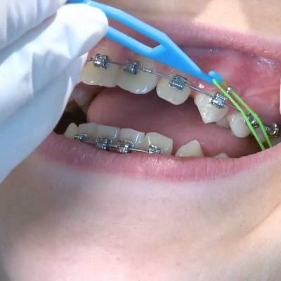 How To Enjoy Perfect Dental Braces For Your Teeth