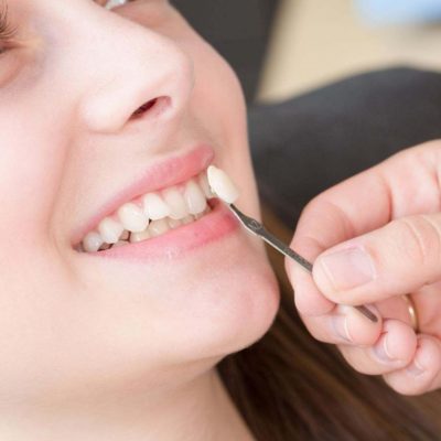 Professional Tooth Whitening Treatments : A Comprehensive Guide