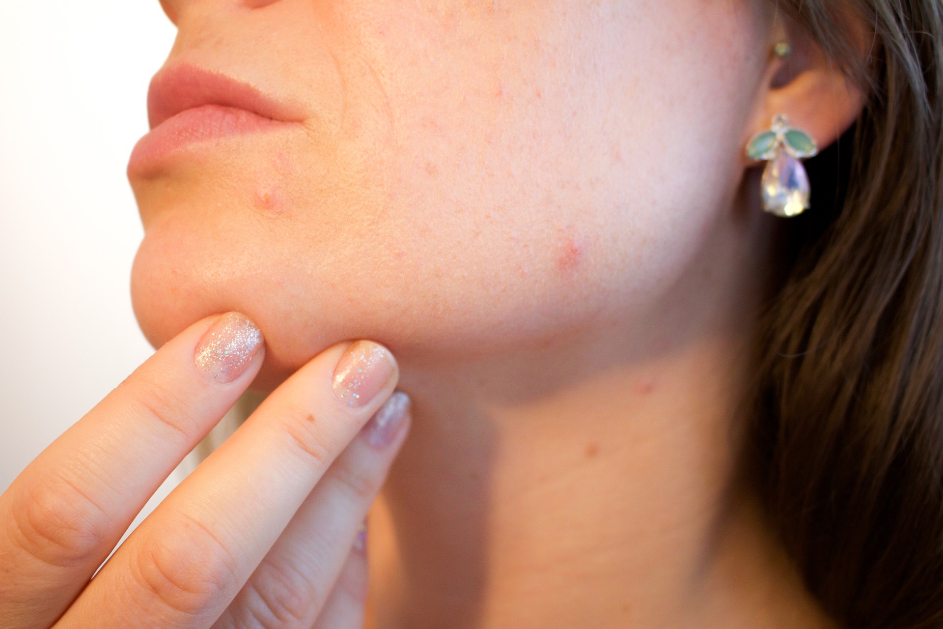 Understanding The Enormous Repercussions Of Acne