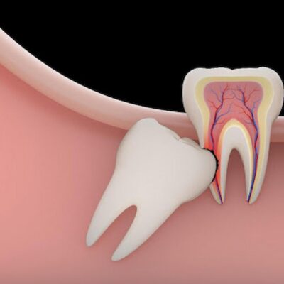 How Do Wisdom Teeth Function?