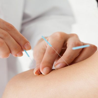 Significant Health Benefits You Can Get From Acupuncture