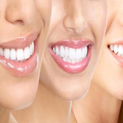 Can Cosmetic Dentist Replace My Missing Tooth?
