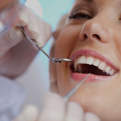 Things To Consider When You’re Considering Veneers