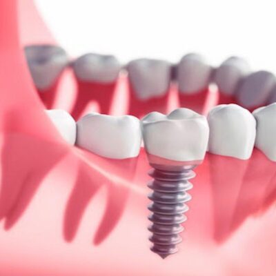 What Important Information Should I Have Regarding Dental Implants?