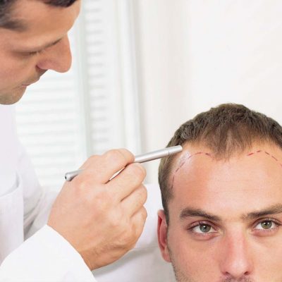 Why Do People Consider Hair Transplants
