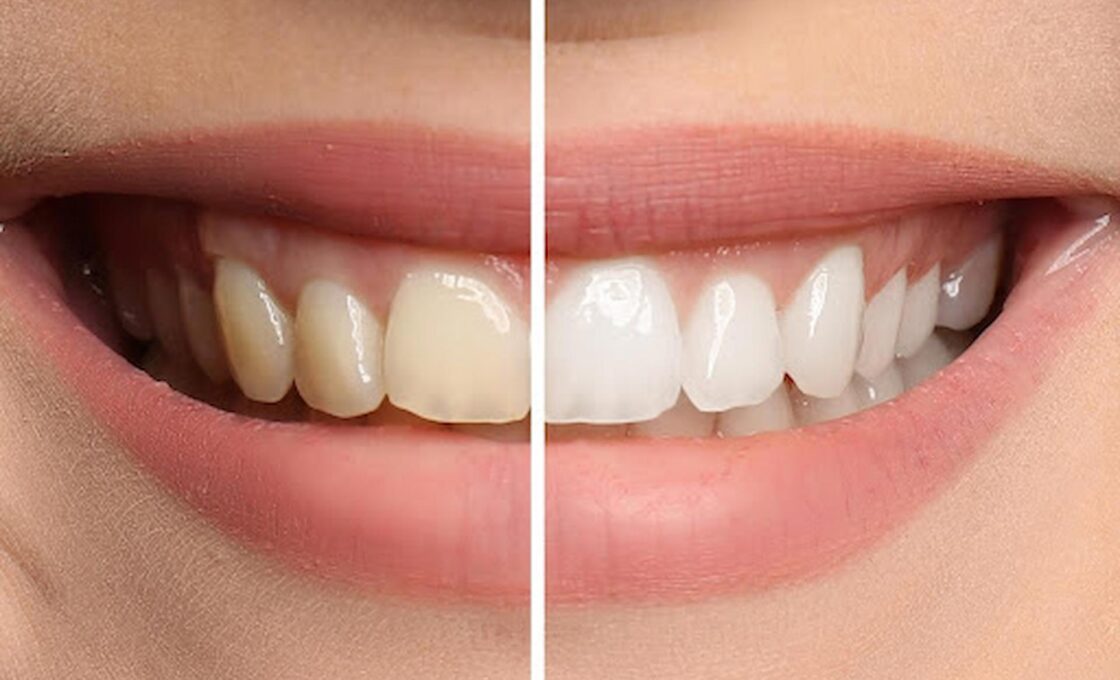 teeth Whitening service