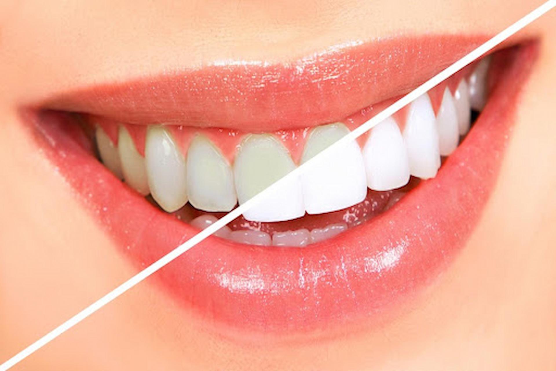 teeth Whitening service